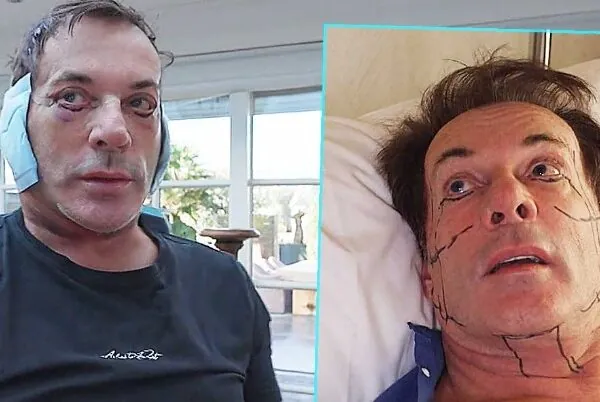 Gerard Joling compleet doorgeslagen met heftige cosmetische ingreep: ´Wat een schrikbeeld!´