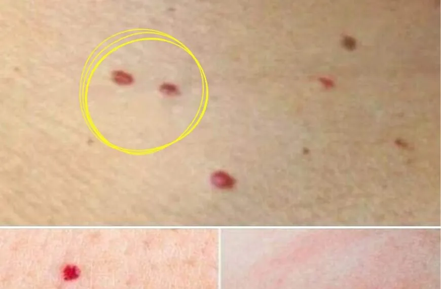 Let op: Als je deze rode stippen op je huid ziet, is het belangrijk om te weten wat ze betekenen
